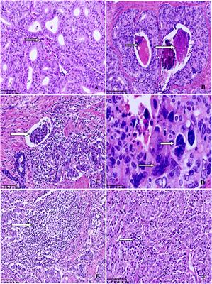 Clinicopathological and molecular analysis of microsatellite instability in prostate cancer: a multi-institutional study in China